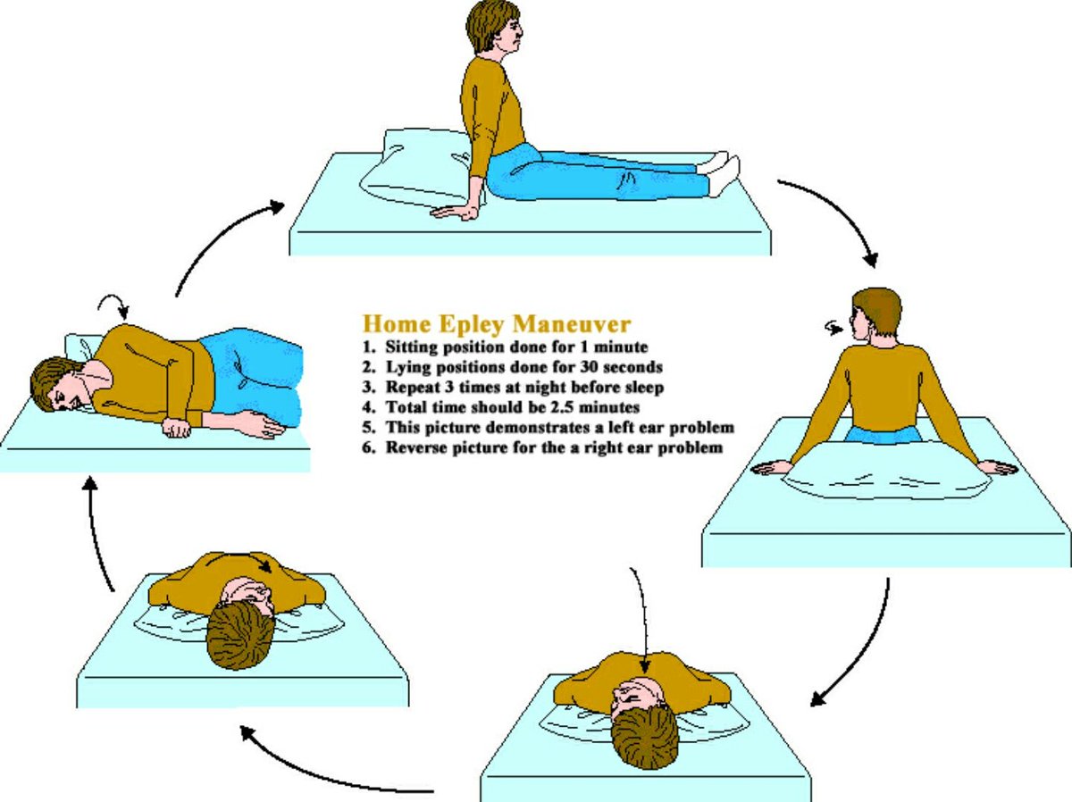 Epley and Semont Maneuvers for Vertigo Cigna